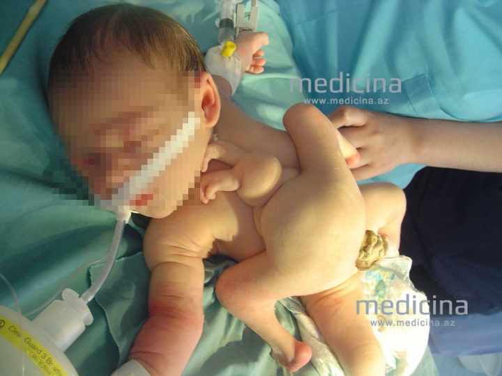 Минздрав о рождении в Баку многорукого и многоногого младенца - ФОТО