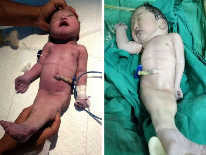 В Индии женщина родила «ребенка-русалку» – ФОТО