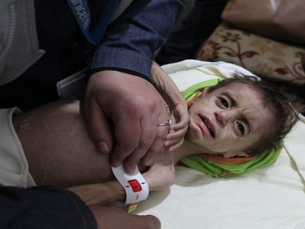 ЮНИСЕФ призвала к срочной эвакуации умирающих без медицинской помощи сирийских детей - ФОТО