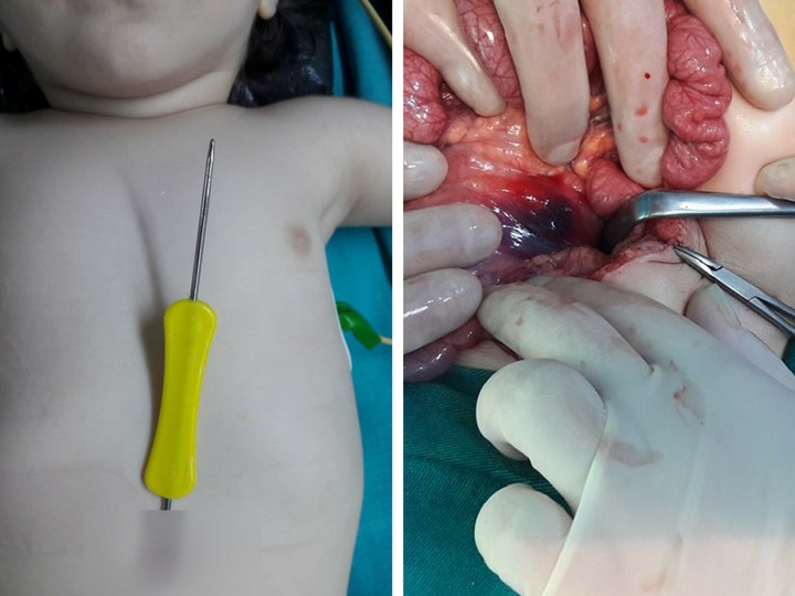 В Баку врачи спасли ребенка, который проткнул живот вязальным крючком – ФОТО