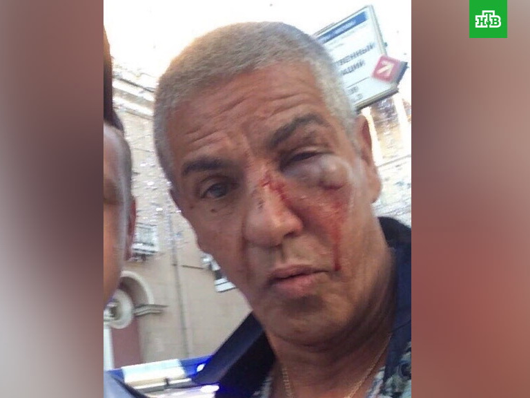 В Сети появился снимок жестоко избитого в Москве актера Сэми Насери – ФОТО