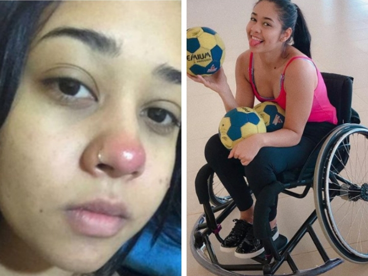 Двадцатилетняя девушка стала инвалидом из-за пирсинга