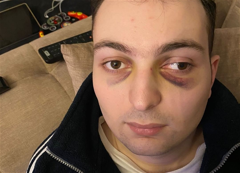 В туалете бакинского молла жестоко избили парня с аутизмом – ФОТО