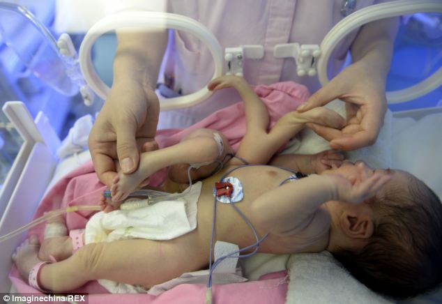 В Китае родился ребенок с четырьмя руками и ногами - ФОТО