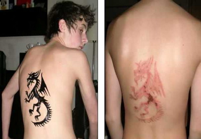  Временные татуировки хной оставили на спинах школьников пожизненные шрамы – ФОТО