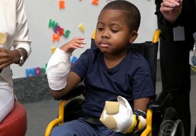 Врачи в США пересадили кисти рук восьмилетнему мальчику - ФОТО
