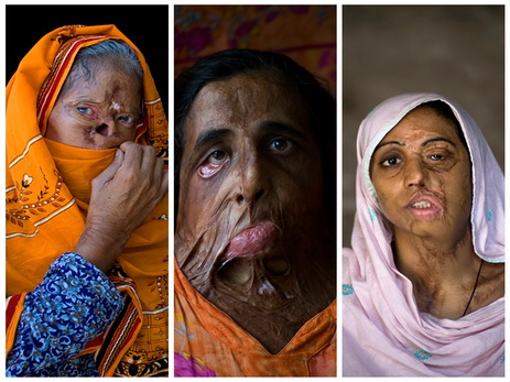Фотоистория о женщинах, изуродованных «во имя чести» - ФОТО