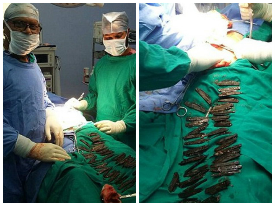 Врачи в Индии извлекли 40 ножей из желудка пациента – ФОТО – ВИДЕО