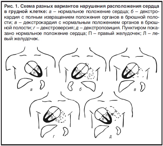 Нормальное расположение. Аномалии расположения сердца. Схема вариантов расположения сердца. Пороки положения сердца. Декстропозиция сердца.