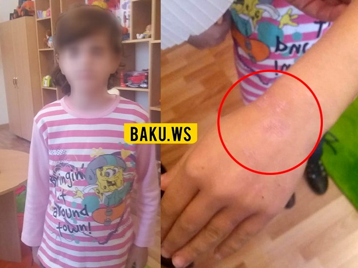 «Мать тушила об мою руку сигареты»: В Азербайджане девочка сбежала из дома, не выдержав издевательств - ФОТО