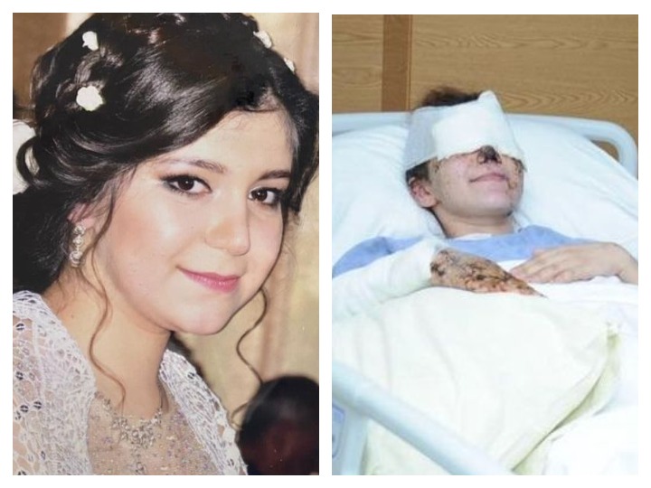 26-летняя жительница Гянджи потеряла зрение в результате ракетного обстрела ВС Армении – ФОТО