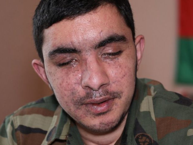 Репортаж о герое нашего времени. В ходе боев в Физулинском районе Амиль Алиев потерял оба глаза – ВИДЕО