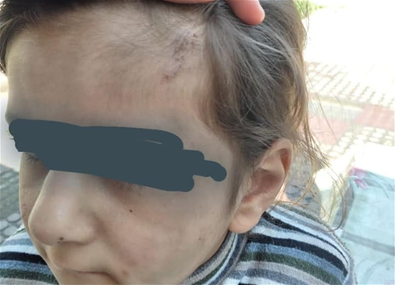 МВД Азербайджана взяло на контроль ситуацию с ребенком, который постоянно подвергается избиениям – ФОТО