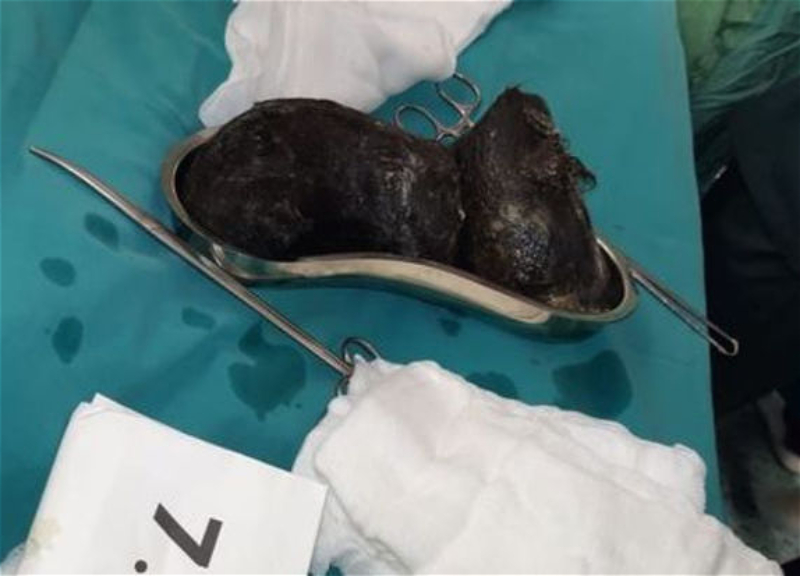 В Баку в желудке 18-летней пациентки обнаружены два камня из волос весом 2 370 граммов - ФОТО