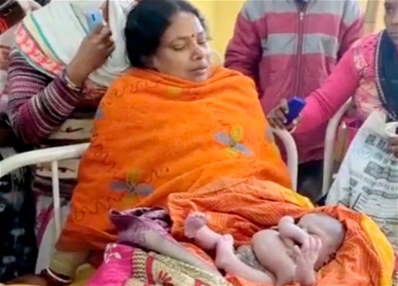 В Индии родился ребенок с восемью конечностями - ВИДЕО