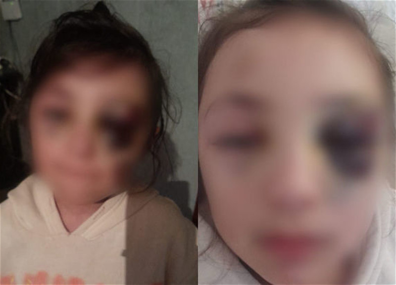 В бакинской школе девочка получила серьезную травму глаза - ФОТО